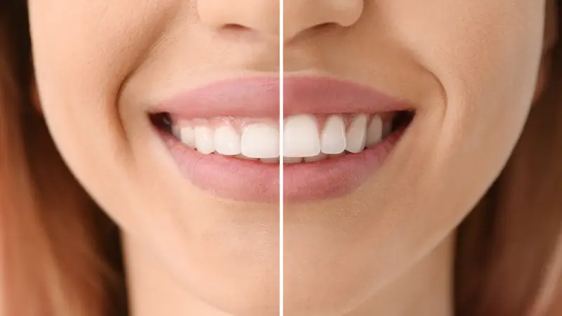 smile before and aftter gum countouring