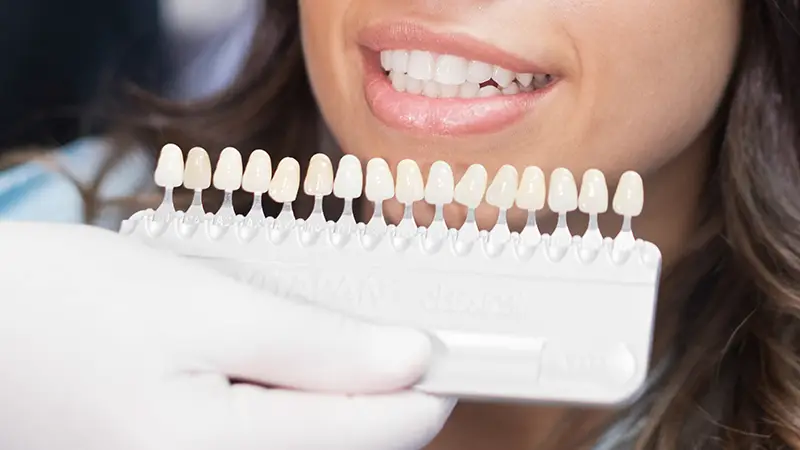 smile with veneer shade palette to match