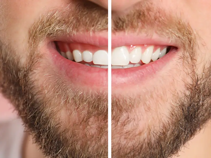 before and after comparison of gum contouring